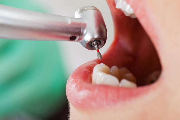 Best Urgent Care for Lost Fillings or Crowns in Bent Creek, NC